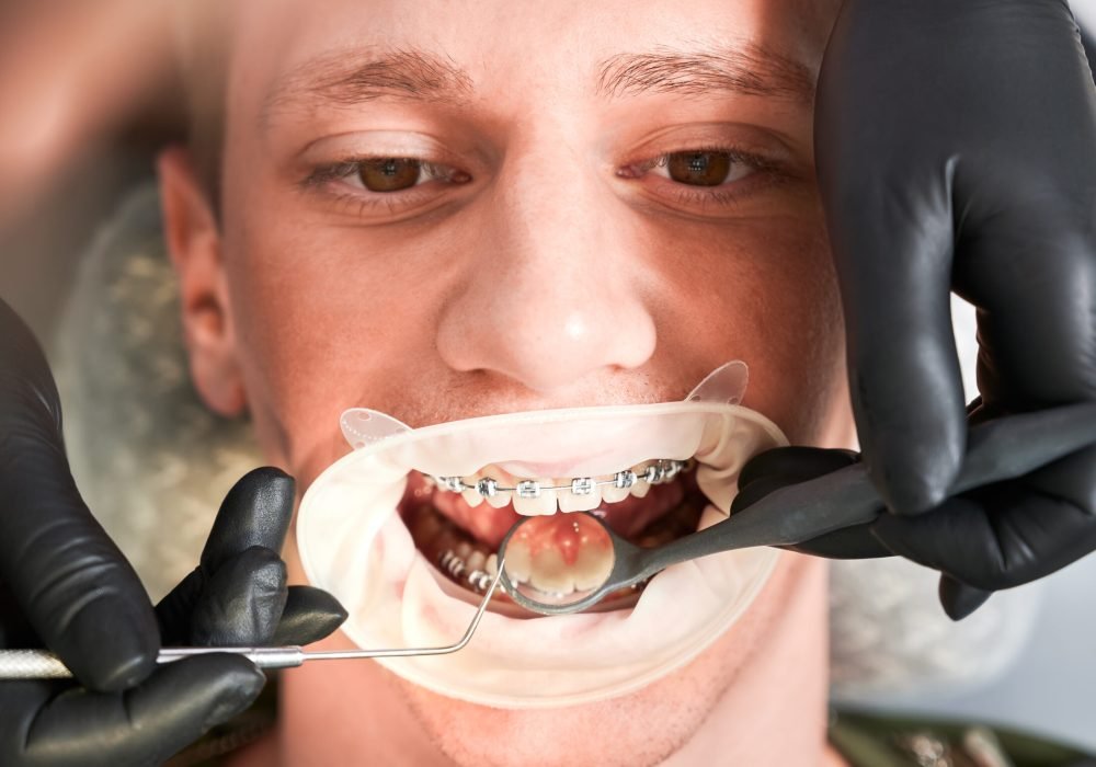 Close up of orthodontist examining man teeth with dental mirror and dental explorer. Male patient with orthodontic braces on teeth being examined by doctor in dental clinic. Concept of dentistry.