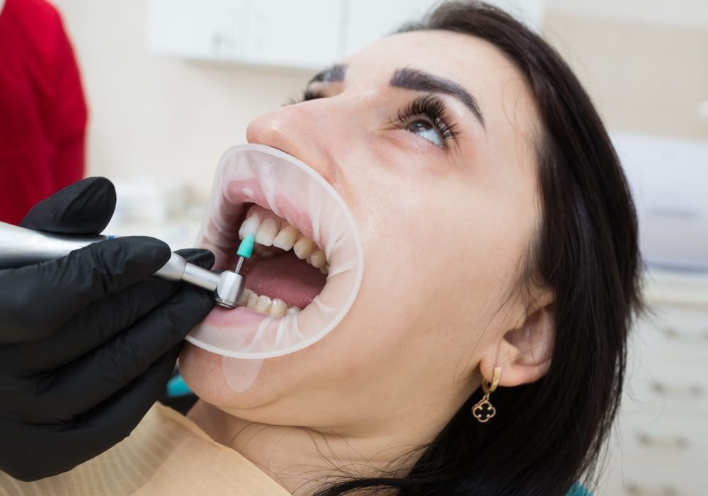 Close-up of an orthodontist wearing gloves fitting veneers on a patient's teeth during an appointment at the clinic. Restoration of teeth up close. Filing veneers. Dental care. A beautiful snow-white smile.