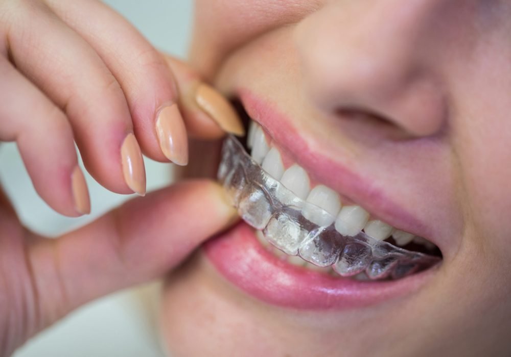 Close-up of woman wearing orthodontic silicone invisible braces