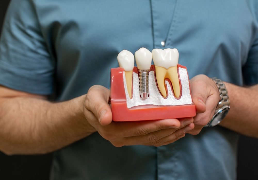 Closeup of the male dentist doctor hands with dental implant model as teaching aid